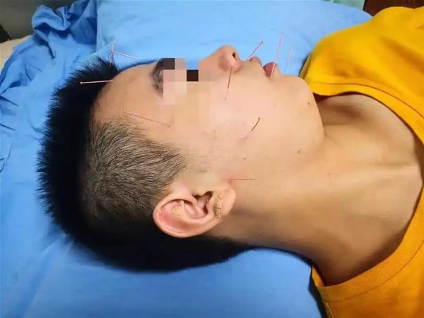 药物在面瘫治疗中扮演什么角色？