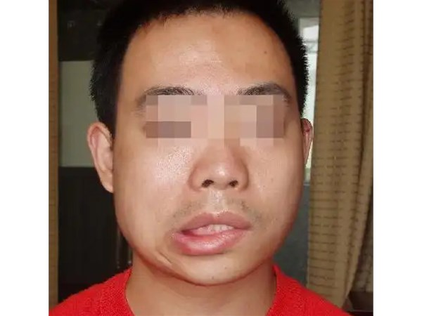 对于严重或长期的面瘫，有哪些高级或替代疗法可以考虑？