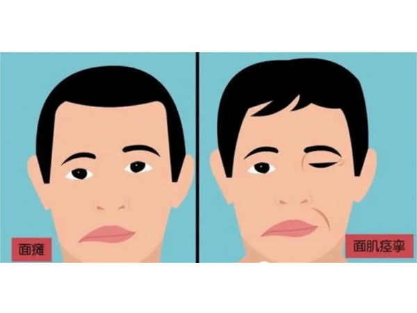 面瘫治疗的预期恢复时间是多少？